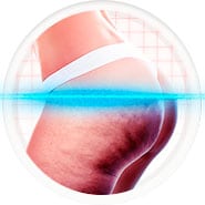 62% MENOS ESTRIAS E CELULITE